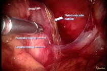 Figure 5. Artist depiction of the approximate location of the neurovascular bundle on the surfaceof the prostate gland from a top view of the prostate gland.