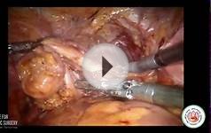 Nerve sparing Robotic Radical Cysto Prostatectomy