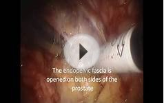 Robotic Prostatectomy(Nerve Sparing) as performed by