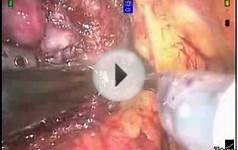 STEP 6b Robotic Prostatectomy Non Nerve Sparing Technique